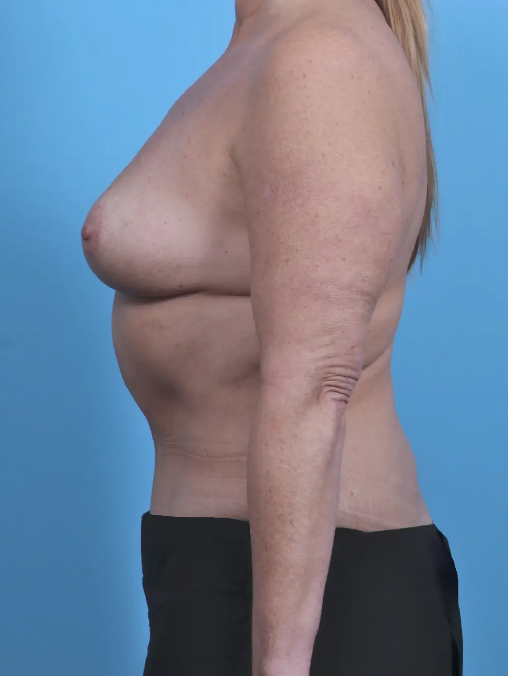 Breast Lift/Reduction w/o Implants Patient Photo - Case 45789 - after view-2