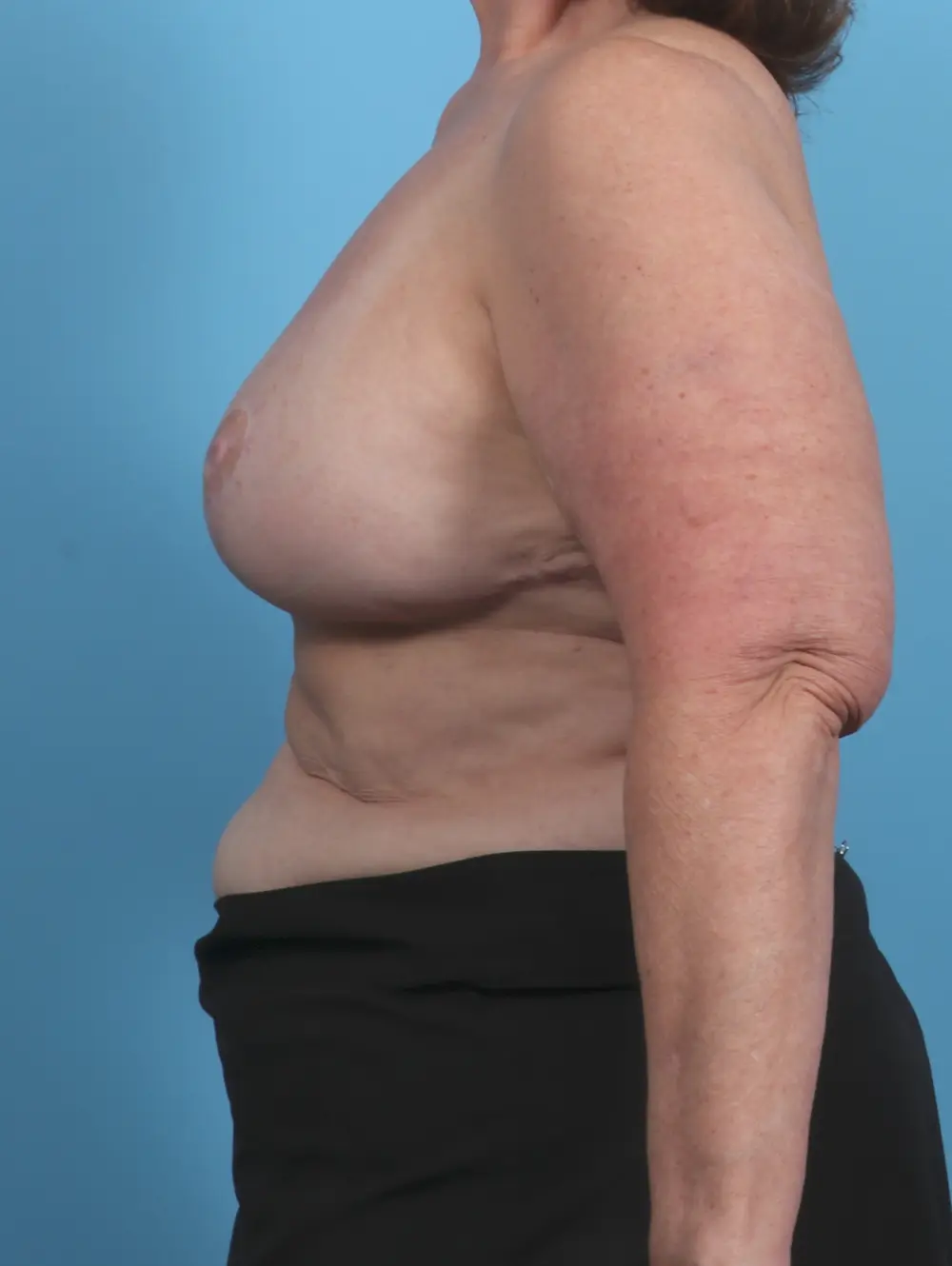 Breast Implant Revision Patient Photo - Case 45805 - after view-2