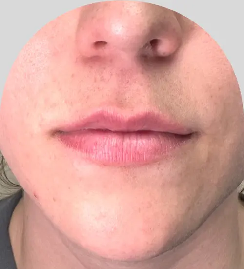 Lip Fillers - Case 45851 - Before