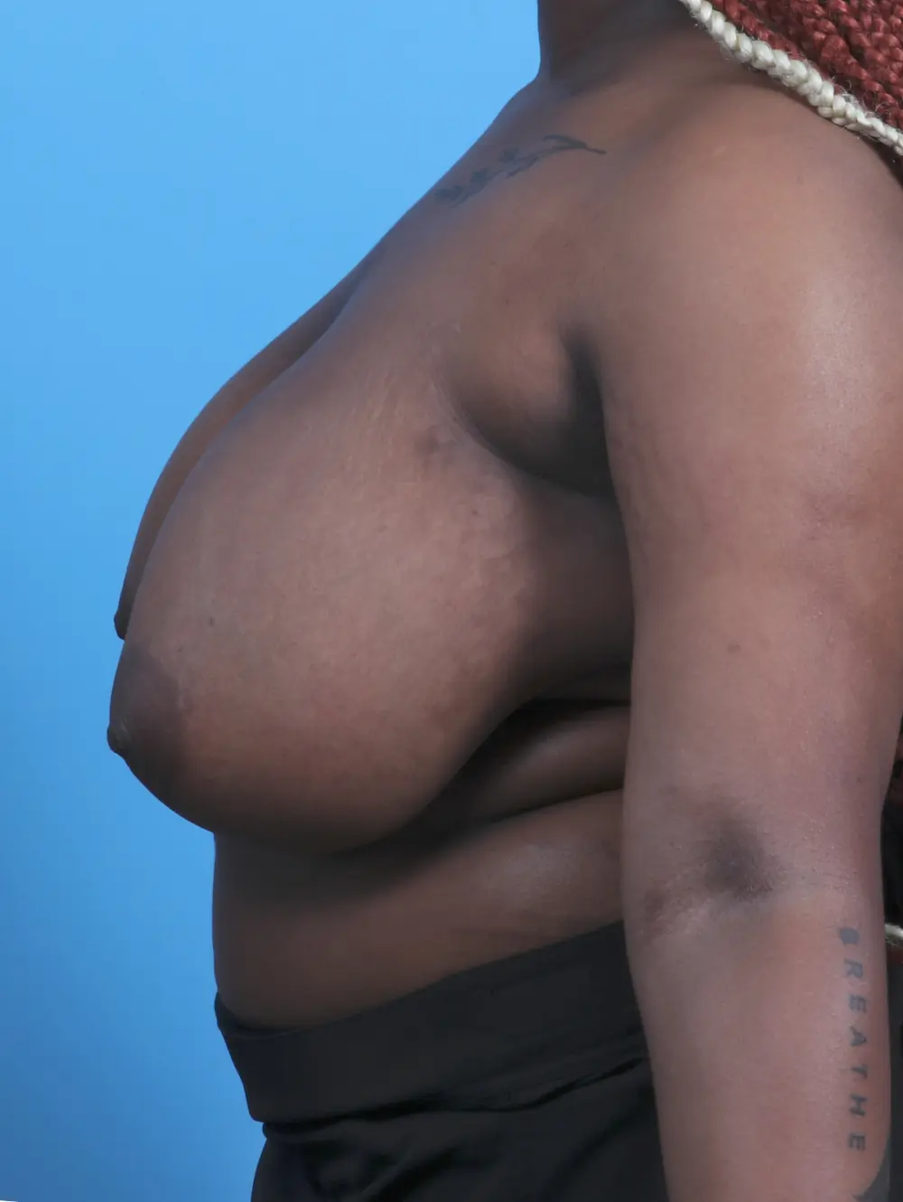 Breast Lift/Reduction w/o Implants Patient Photo - Case 45885 - before view-2