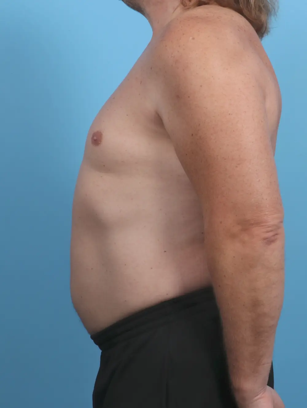 Liposuction Patient Photo - Case 45893 - after view-2