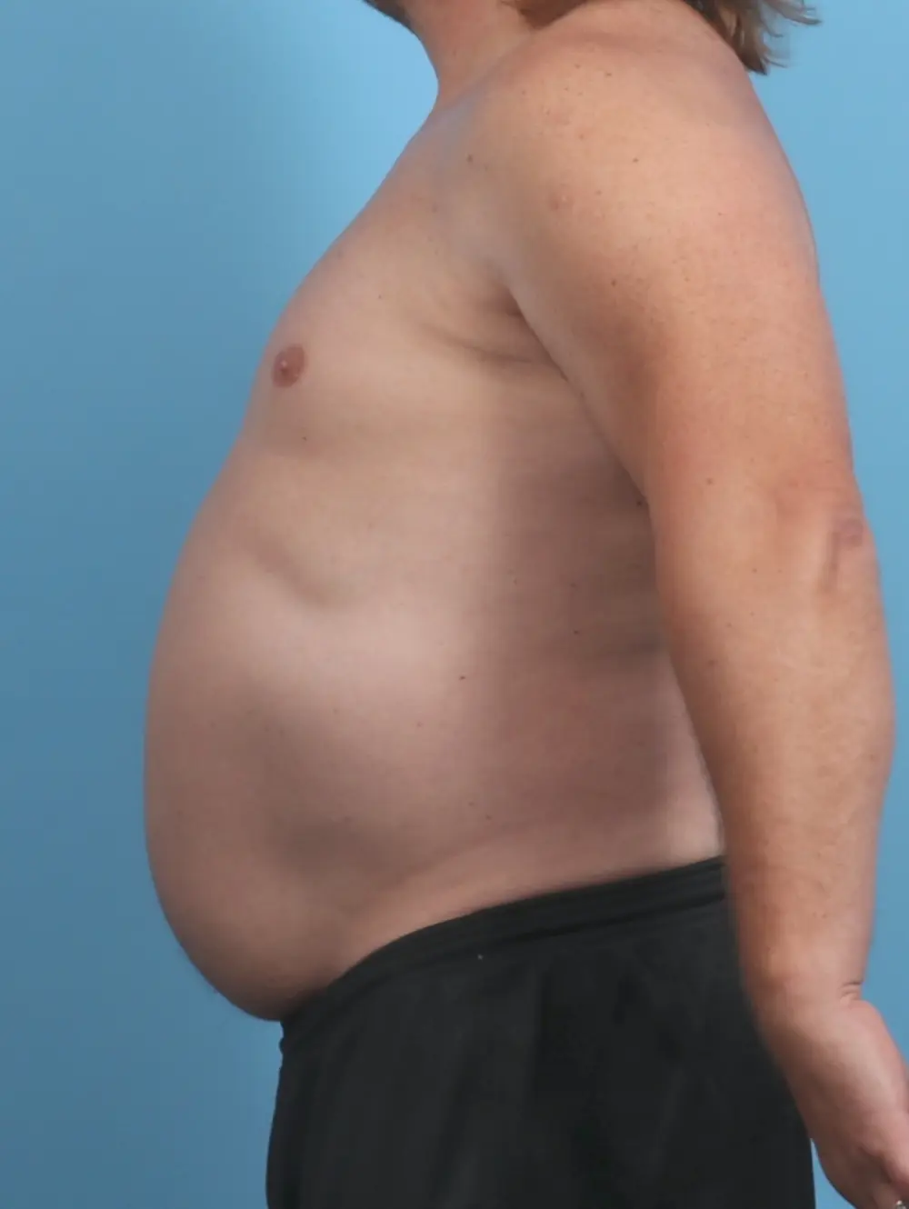 Liposuction Patient Photo - Case 45893 - before view-2