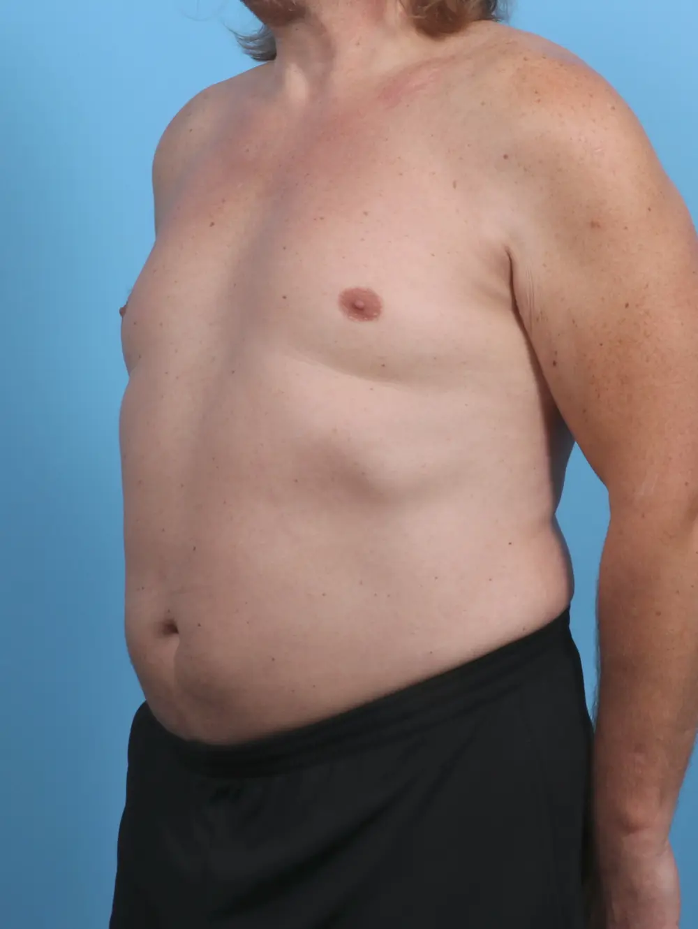Liposuction Patient Photo - Case 45893 - after view-1