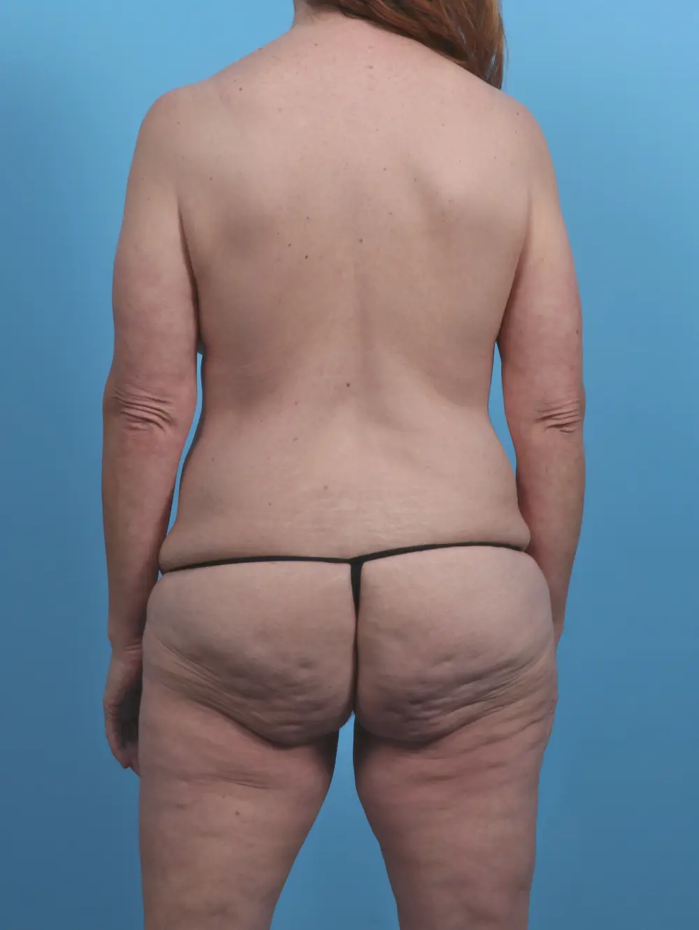 After Weight Loss Patient Photo - Case 45944 - before view-3