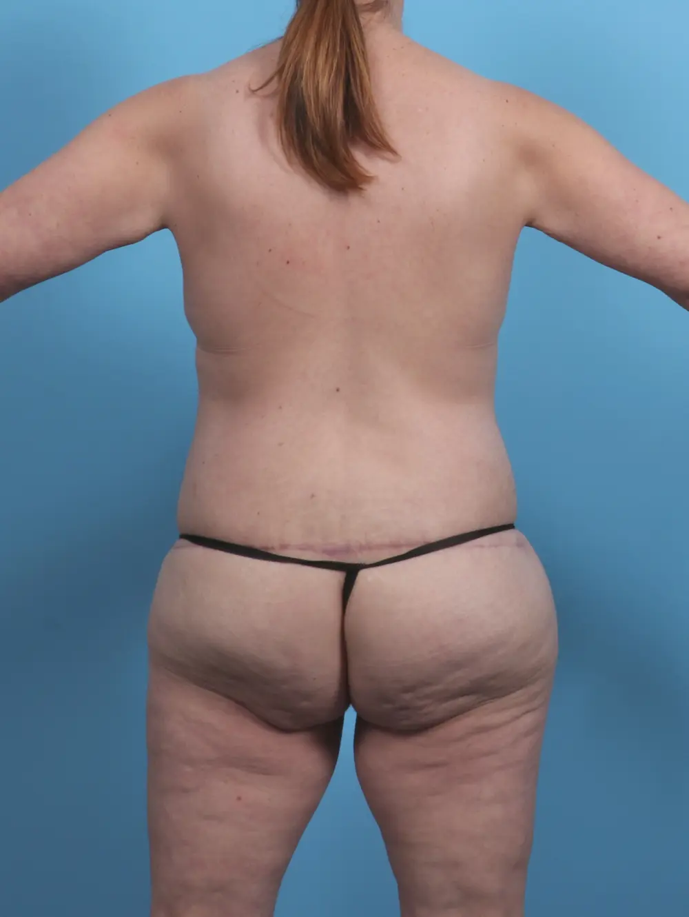 After Weight Loss Patient Photo - Case 45944 - after view-3