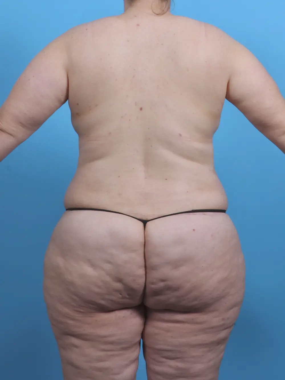 Body Lift Patient Photo - Case 45960 - after view-3