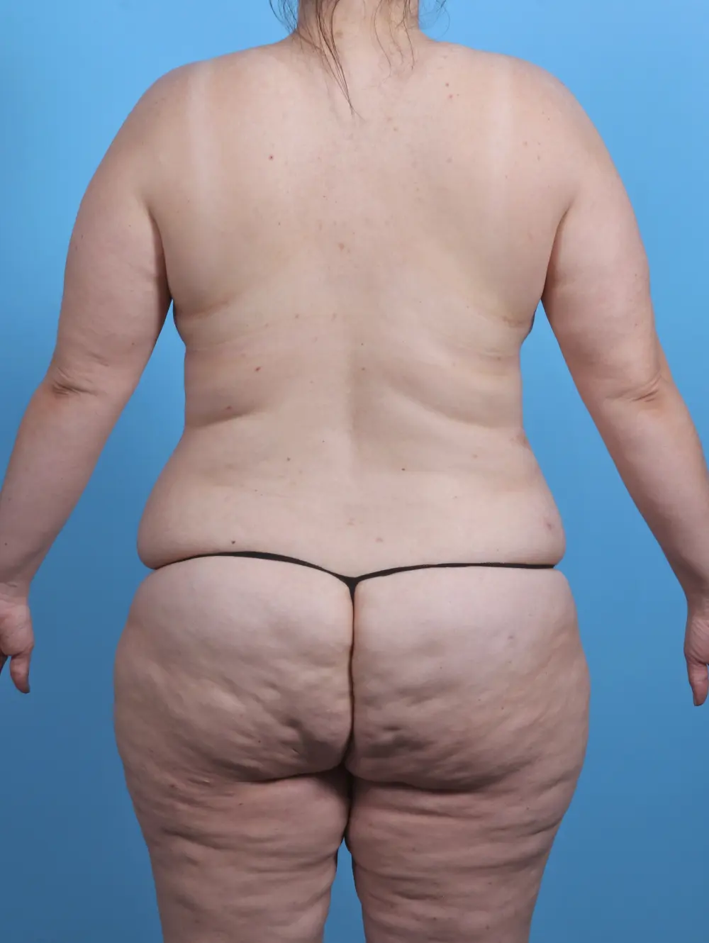 Body Lift Patient Photo - Case 45960 - before view-3