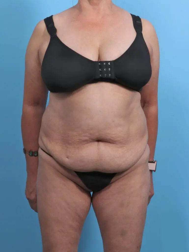 Tummy Tuck - Case 45970 - Before