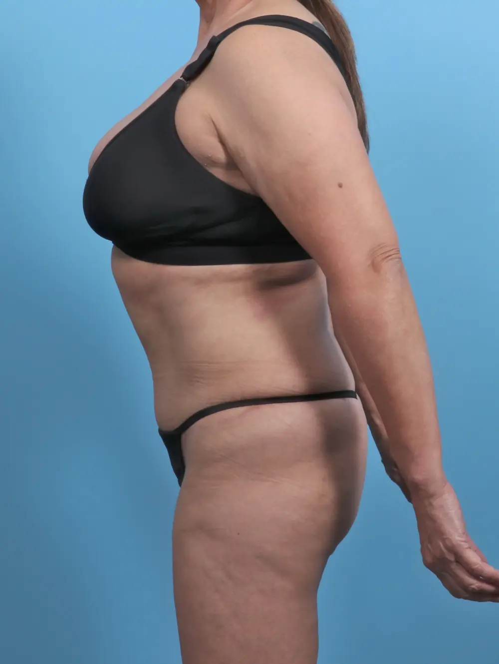 Tummy Tuck Patient Photo - Case 45970 - after view-2