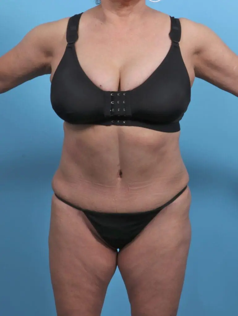 Tummy Tuck - Case 45970 - After