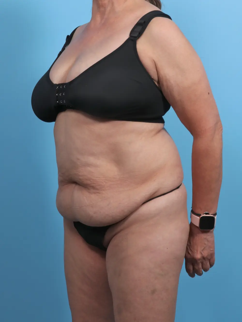 Tummy Tuck Patient Photo - Case 45970 - before view-1