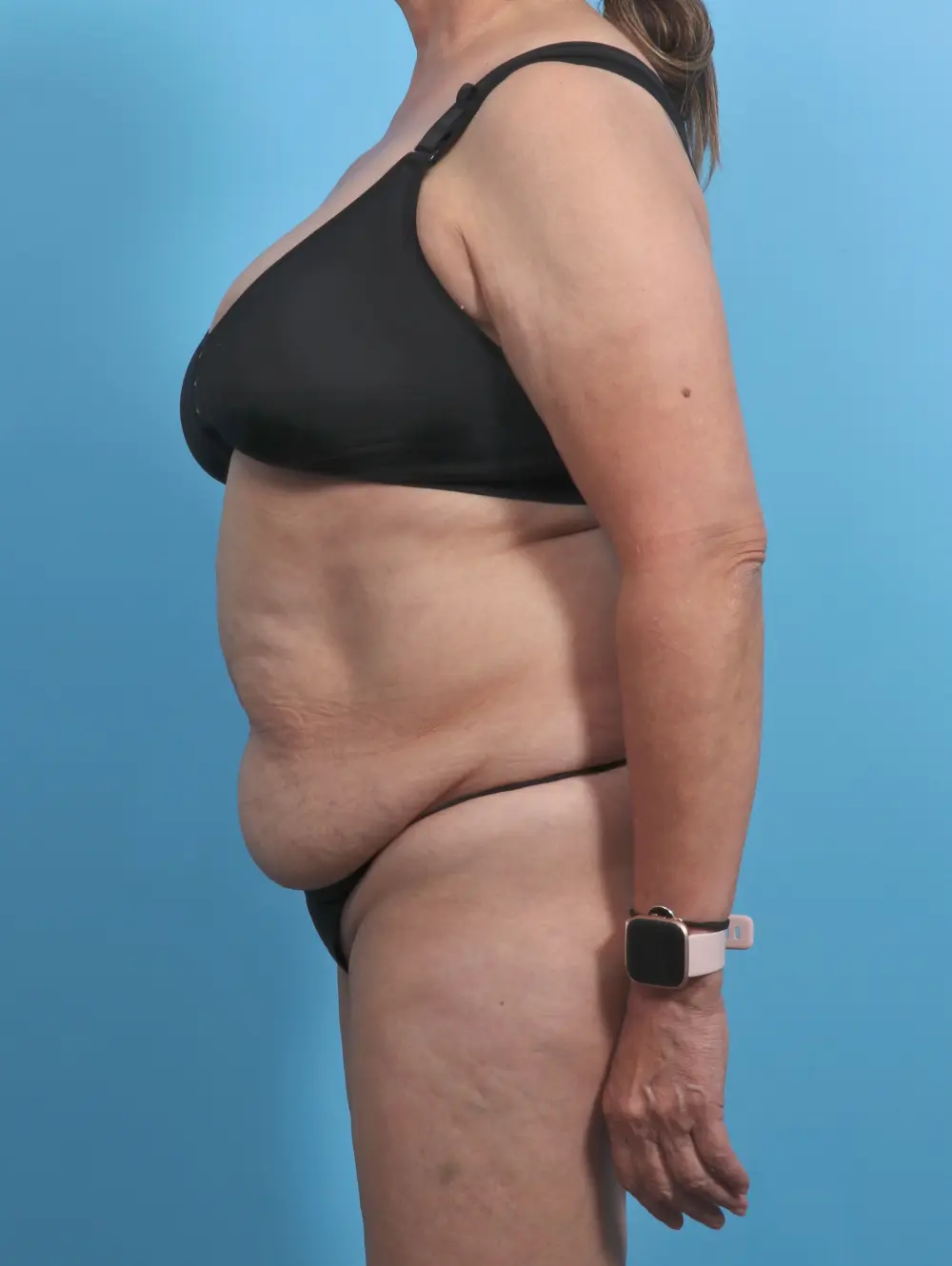 Tummy Tuck Patient Photo - Case 45970 - before view-2