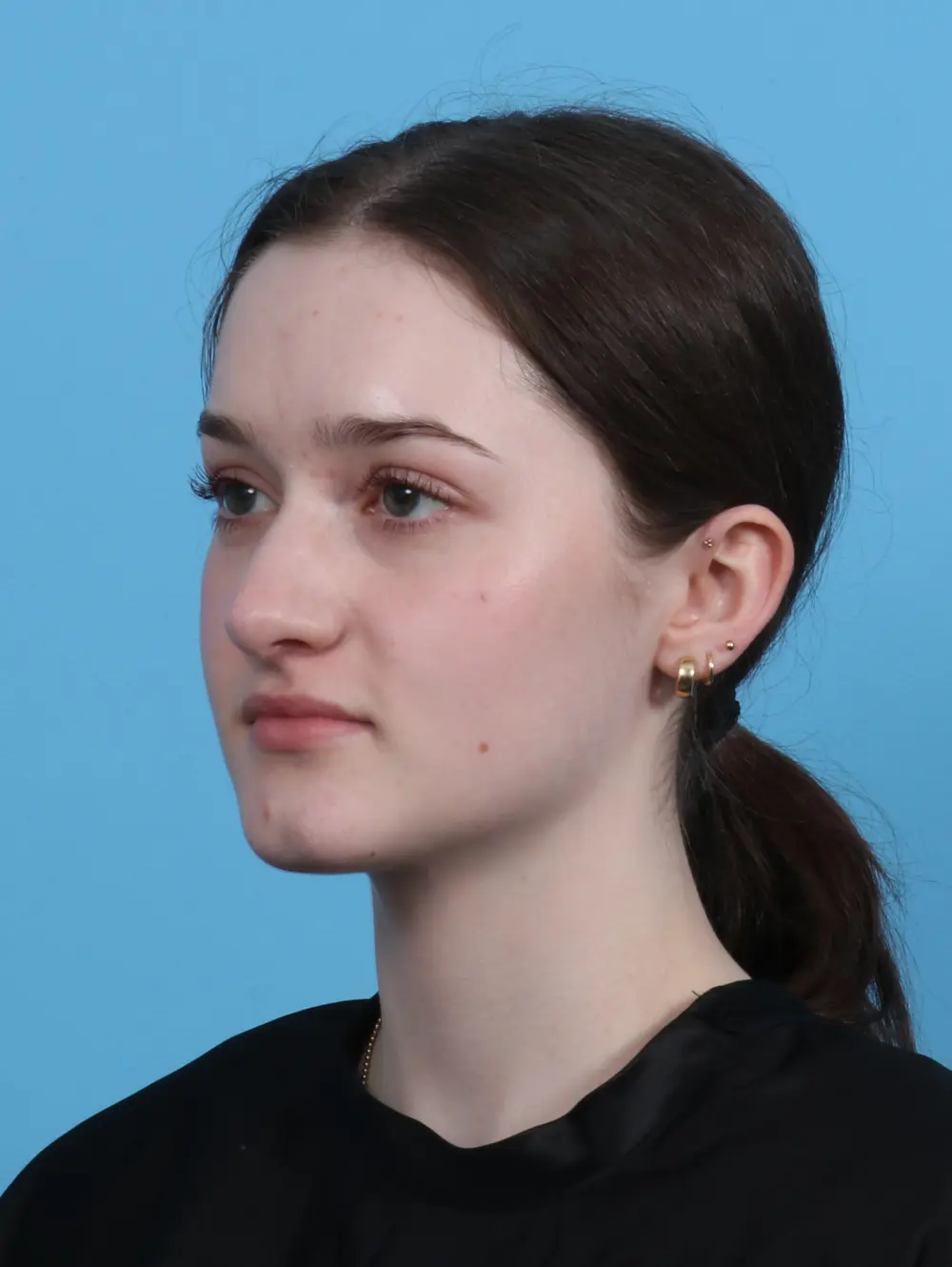 Rhinoplasty Patient Photo - Case 45980 - before view-1