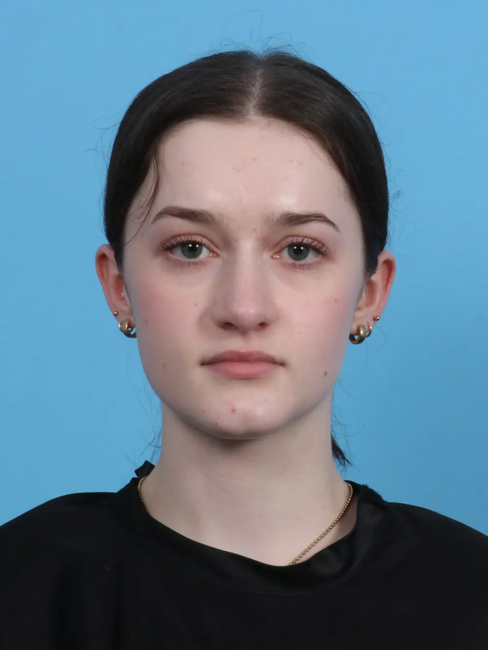 Rhinoplasty Patient Photo - Case 45980 - before view-2