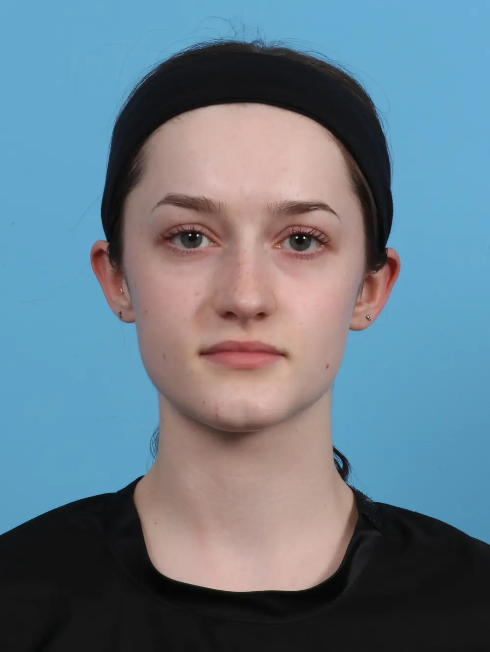 Rhinoplasty Patient Photo - Case 45980 - after view-2