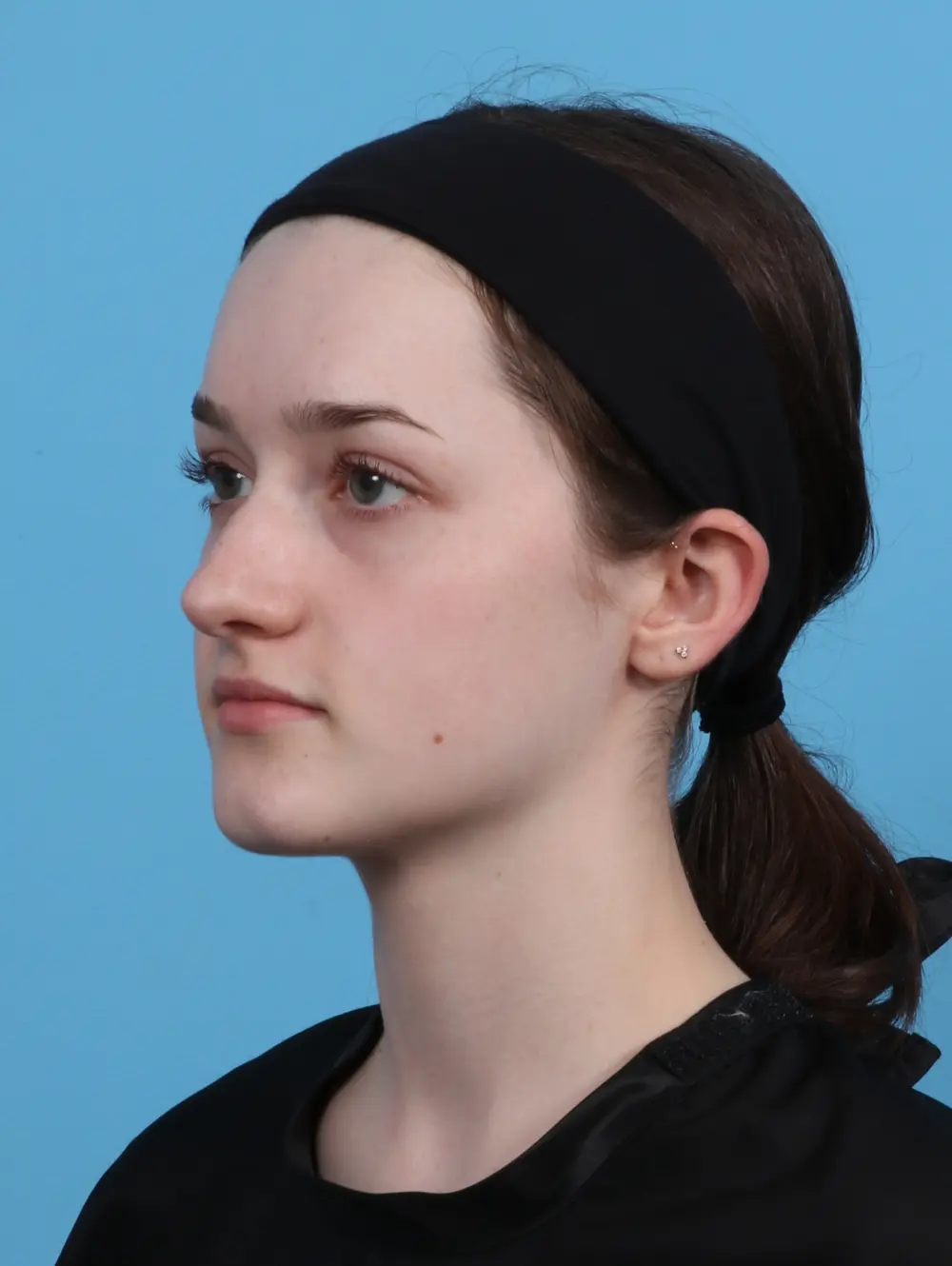 Rhinoplasty Patient Photo - Case 45980 - after view-1