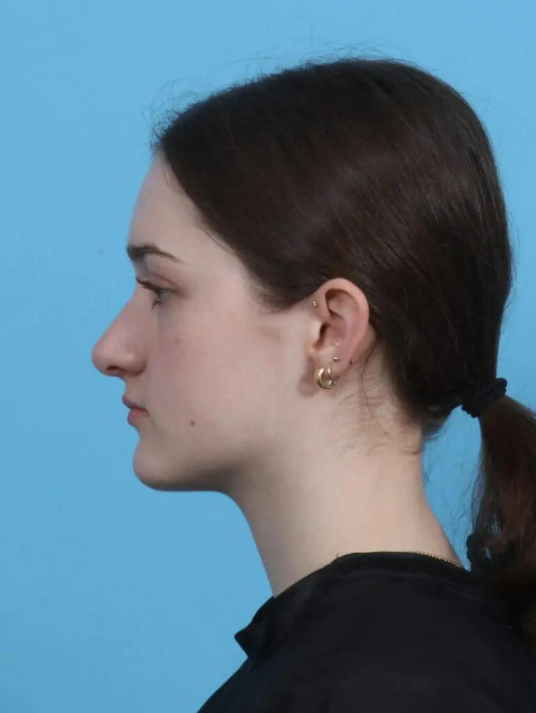Rhinoplasty - Case 45980 - Before