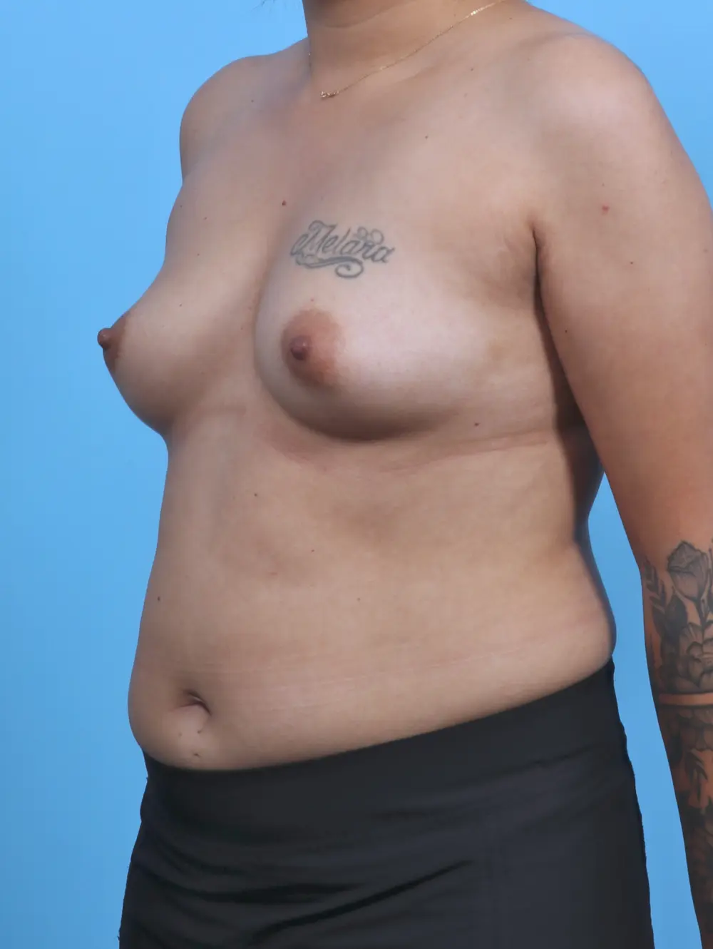 Breast Augmentation Patient Photo - Case 46013 - before view-1