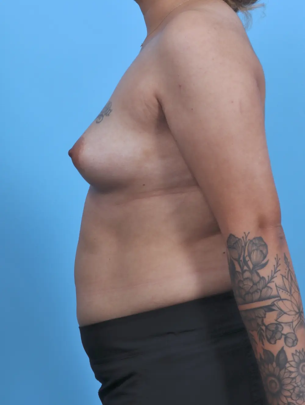 Breast Augmentation Patient Photo - Case 46013 - before view-2