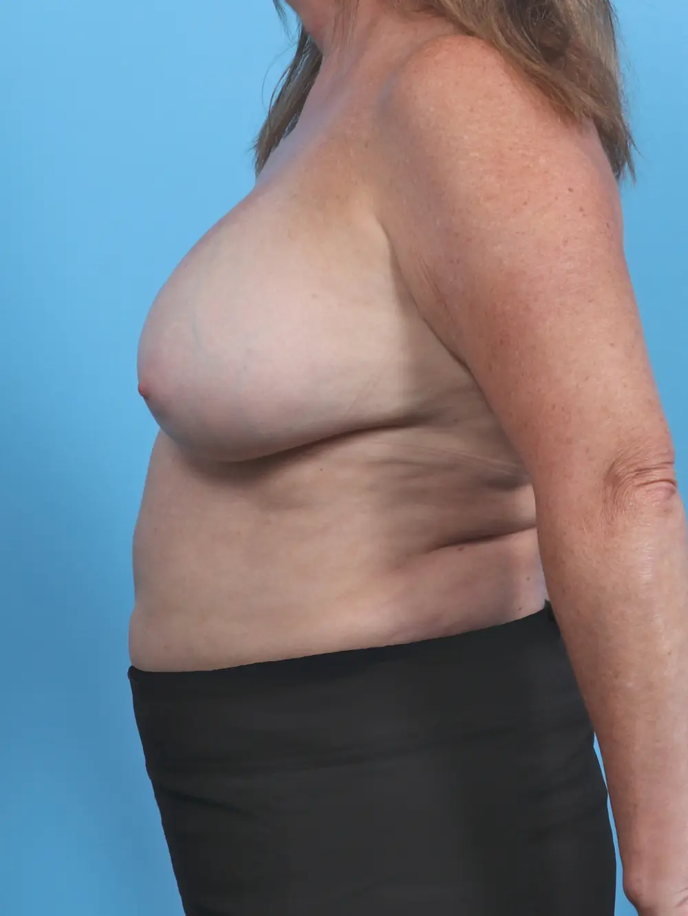 Breast Lift/Reduction with Implants Patient Photo - Case 46021 - before view-2