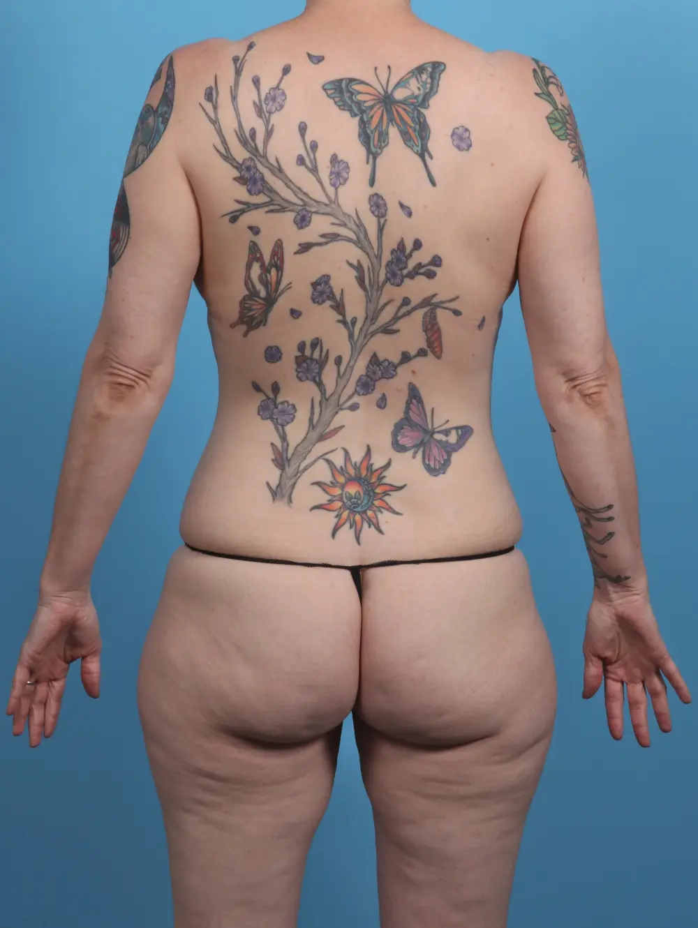 Breast Lift/Reduction w/o Implants Patient Photo - Case 46029 - before view-3