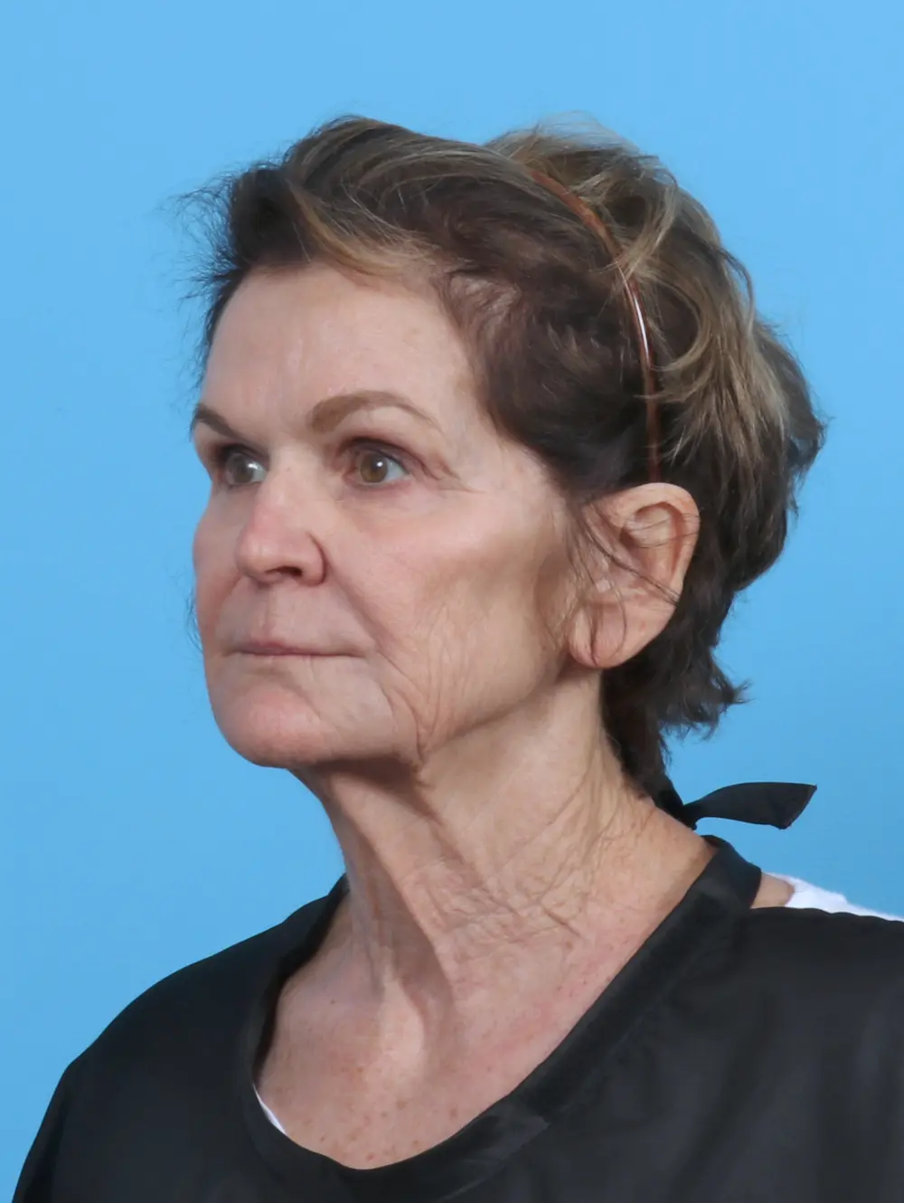 Facelift / Neck Lift Patient Photo - Case 46239 - before view-1