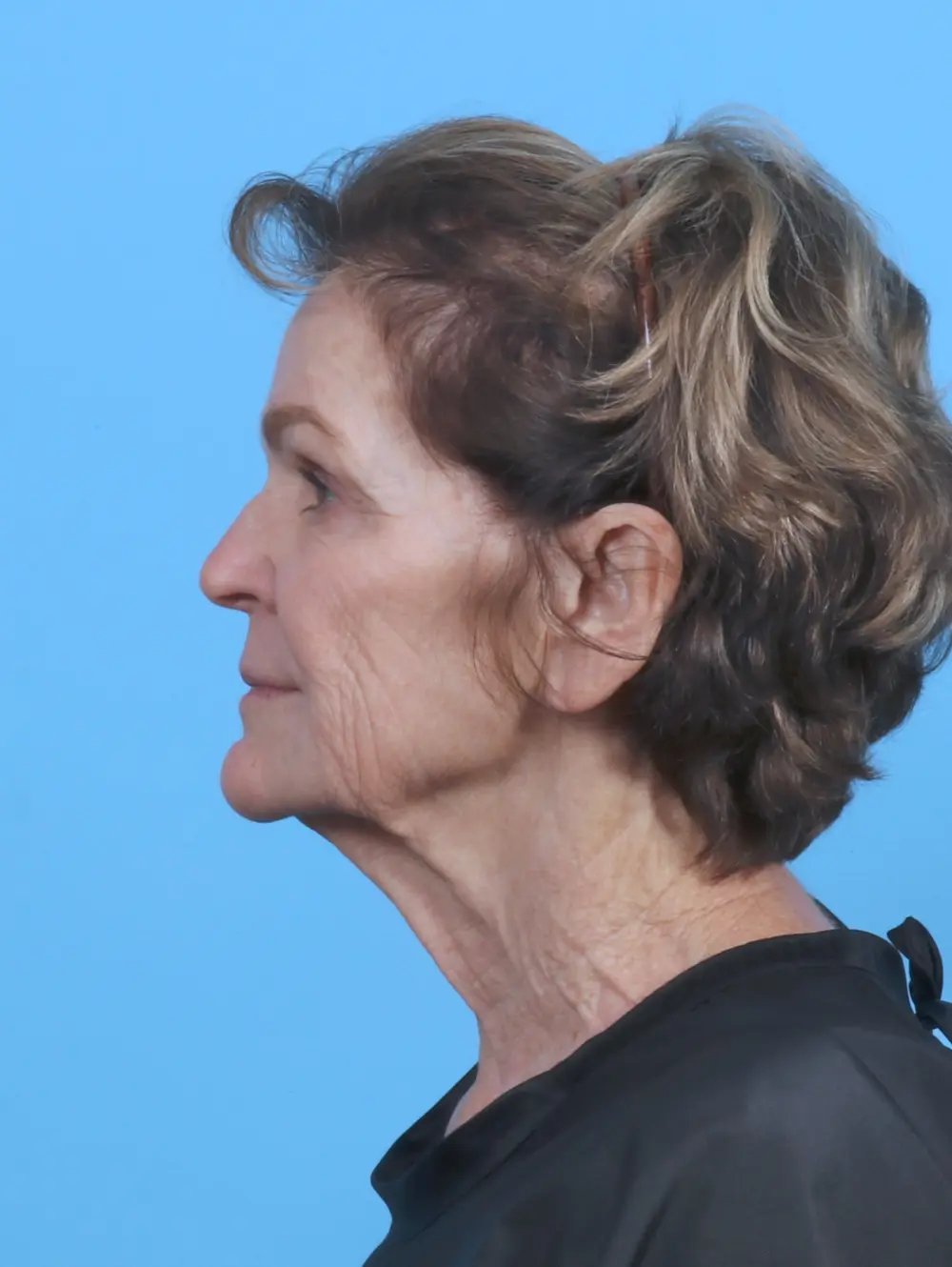 Facelift / Neck Lift Patient Photo - Case 46239 - before view-2