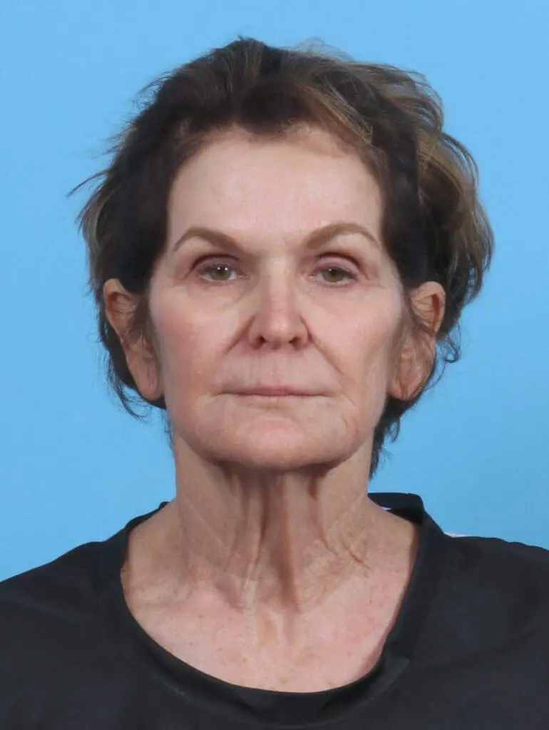 Facelift / Neck Lift - Case 46239 - Before