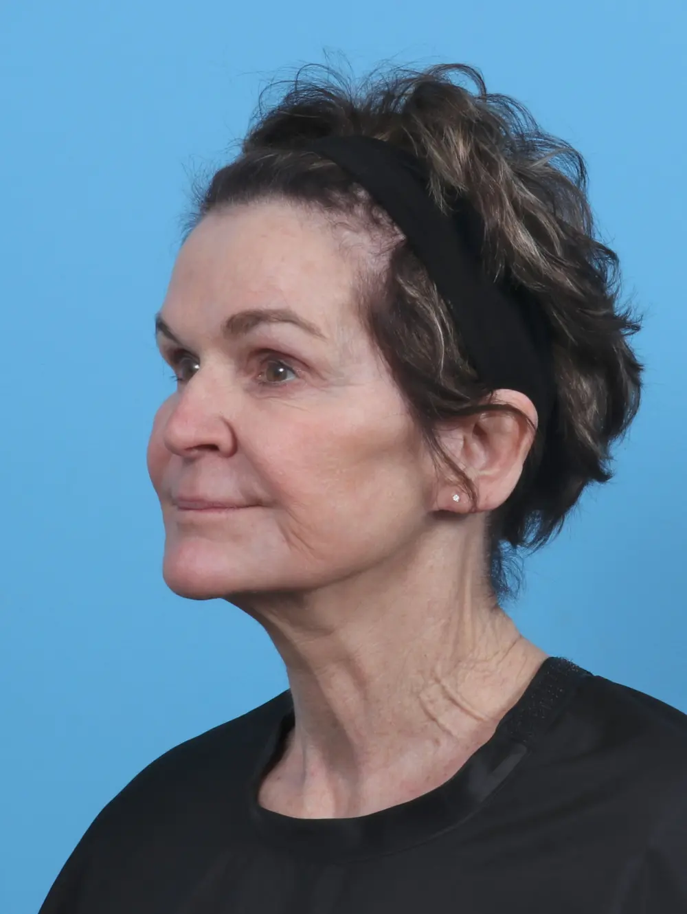 Facelift / Neck Lift Patient Photo - Case 46239 - after view-1