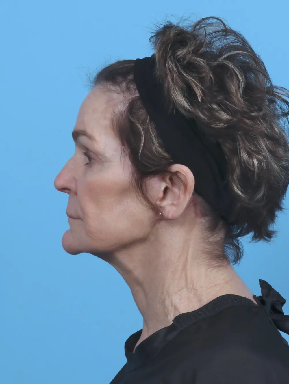 Facelift / Neck Lift Patient Photo - Case 46239 - after view-2