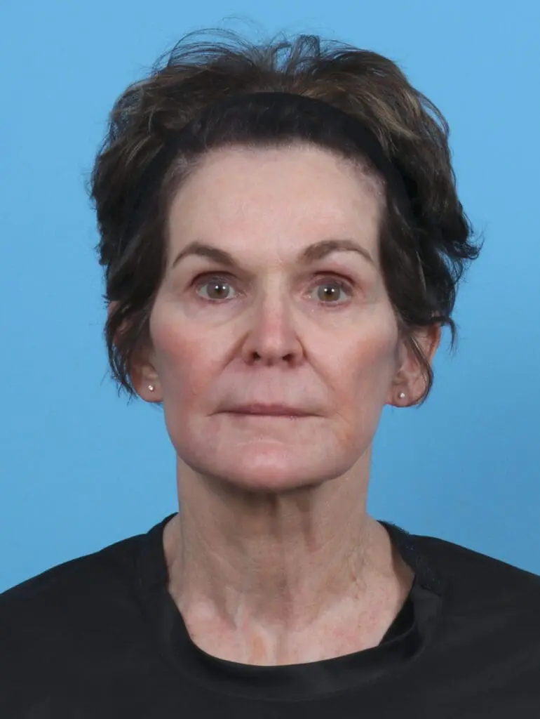 Facelift / Neck Lift - Case 46239 - After