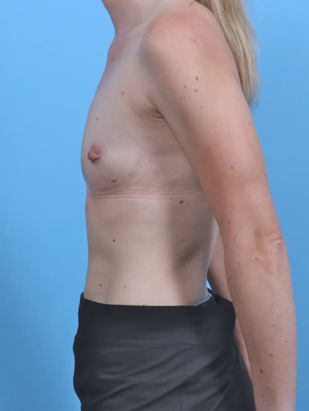 Breast Augmentation Patient Photo - Case 46247 - before view-2