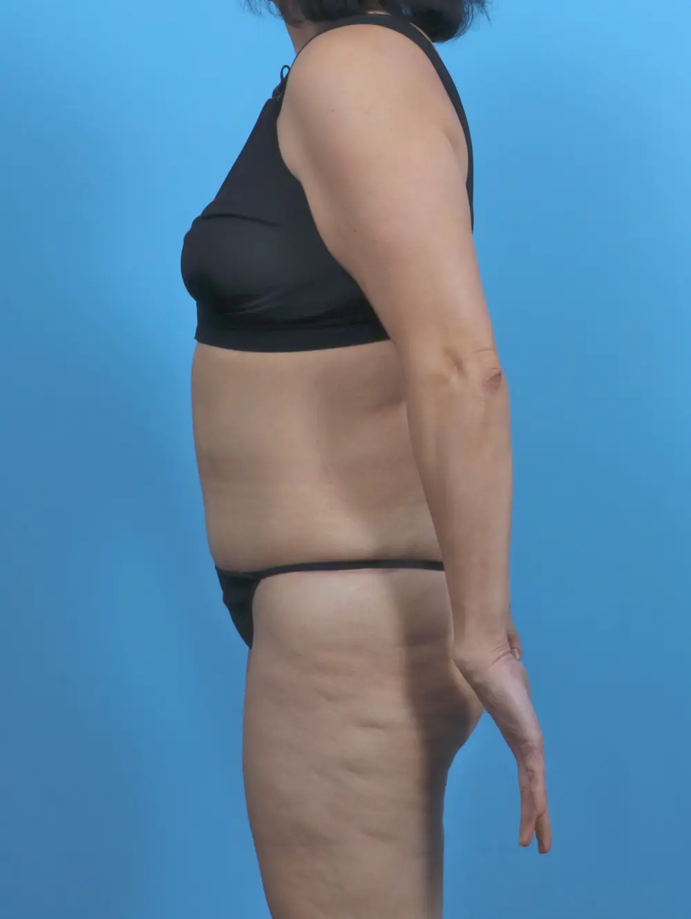 Tummy Tuck Patient Photo - Case 46269 - after view-2