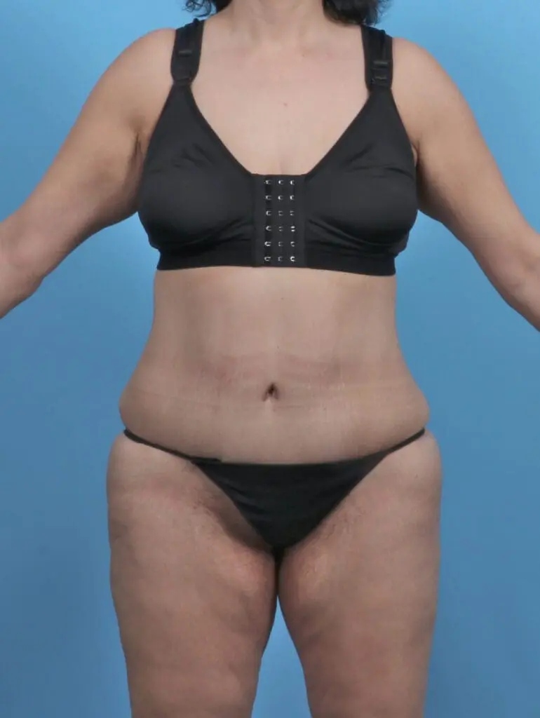 Tummy Tuck - Case 46269 - After