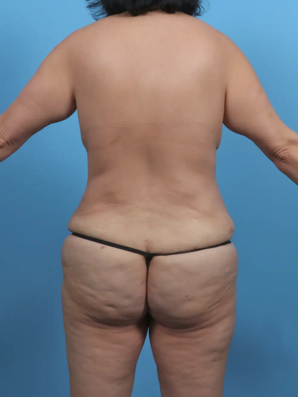 Tummy Tuck Patient Photo - Case 46269 - after view-3