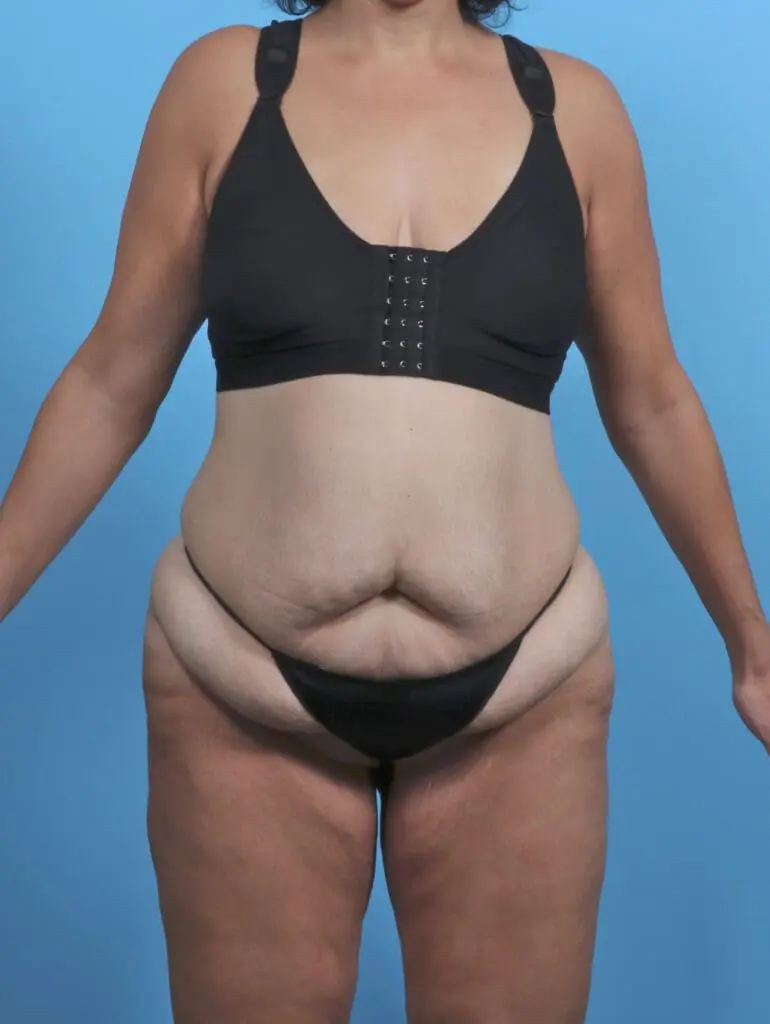 Tummy Tuck - Case 46269 - Before