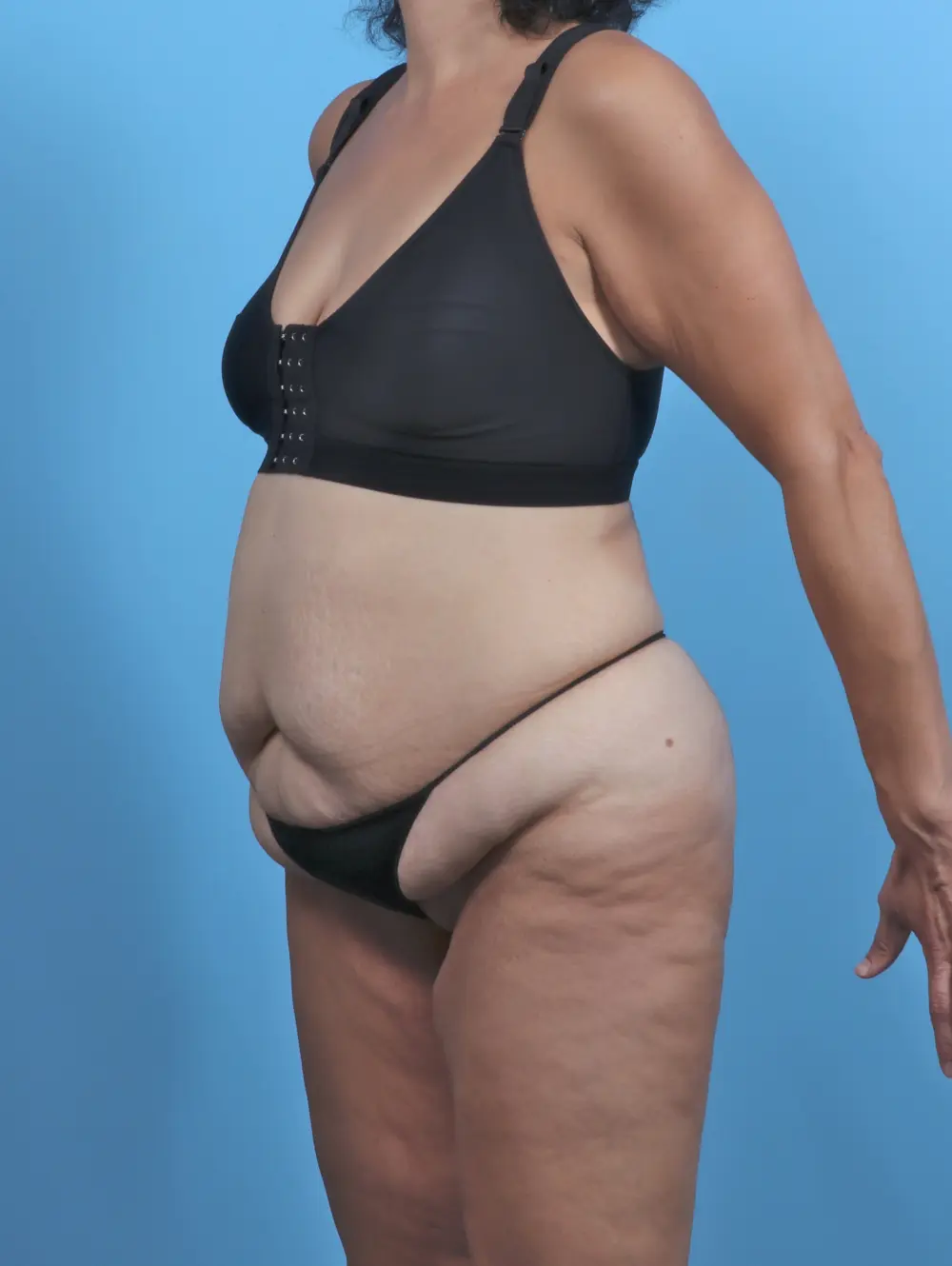 Tummy Tuck Patient Photo - Case 46269 - before view-1