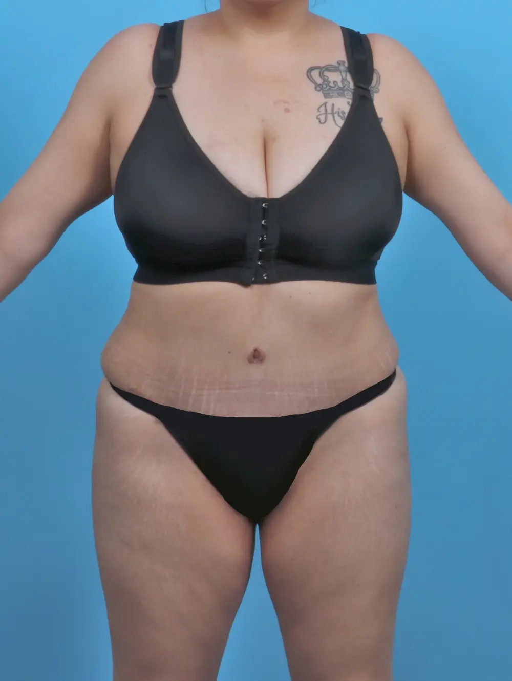 Tummy Tuck Patient Photo - Case 46281 - after view