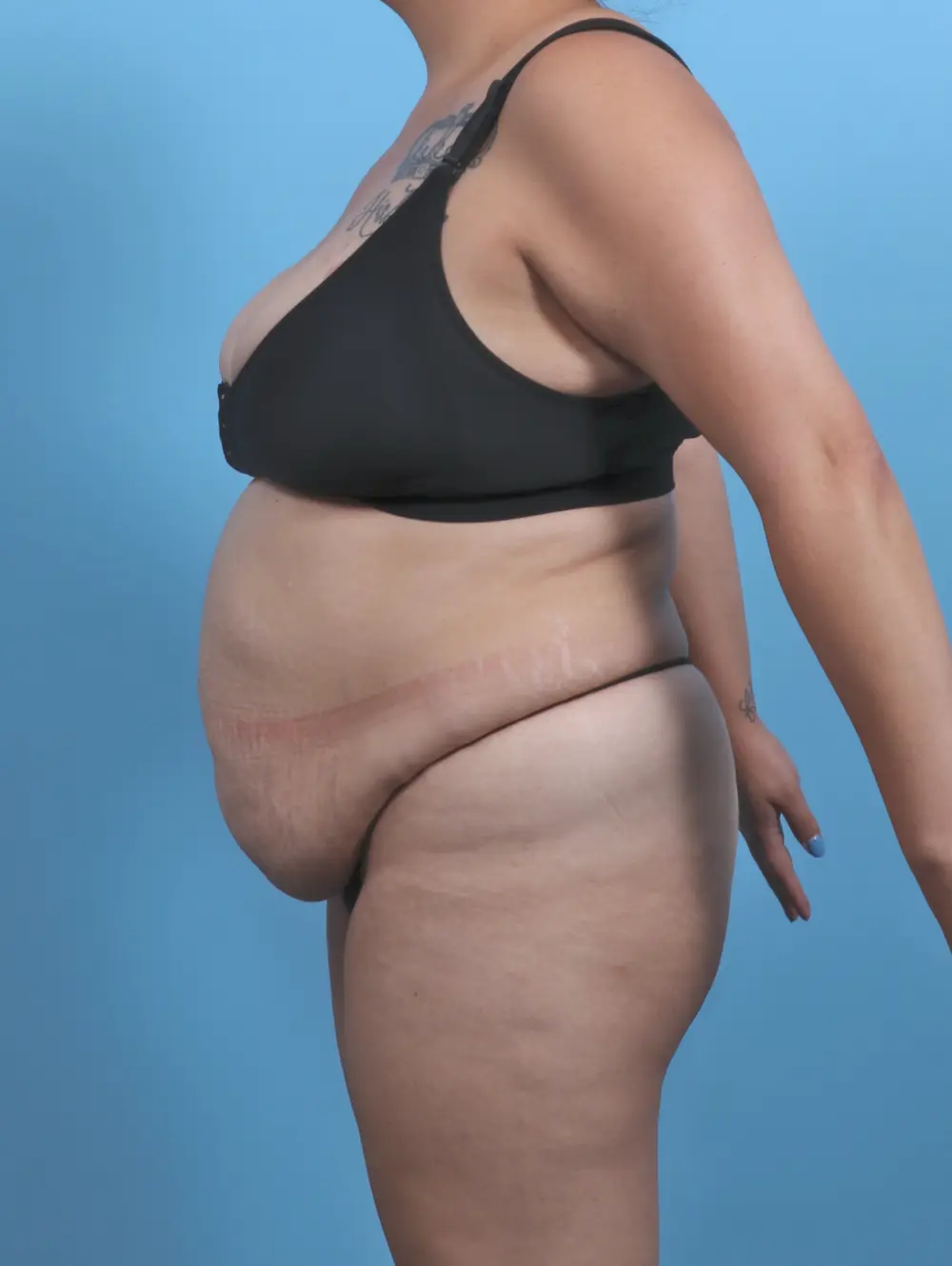 Tummy Tuck Patient Photo - Case 46281 - before view-2