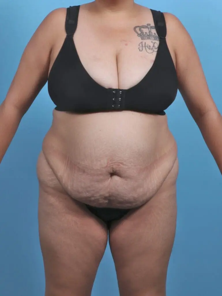 Tummy Tuck - Case 46281 - Before