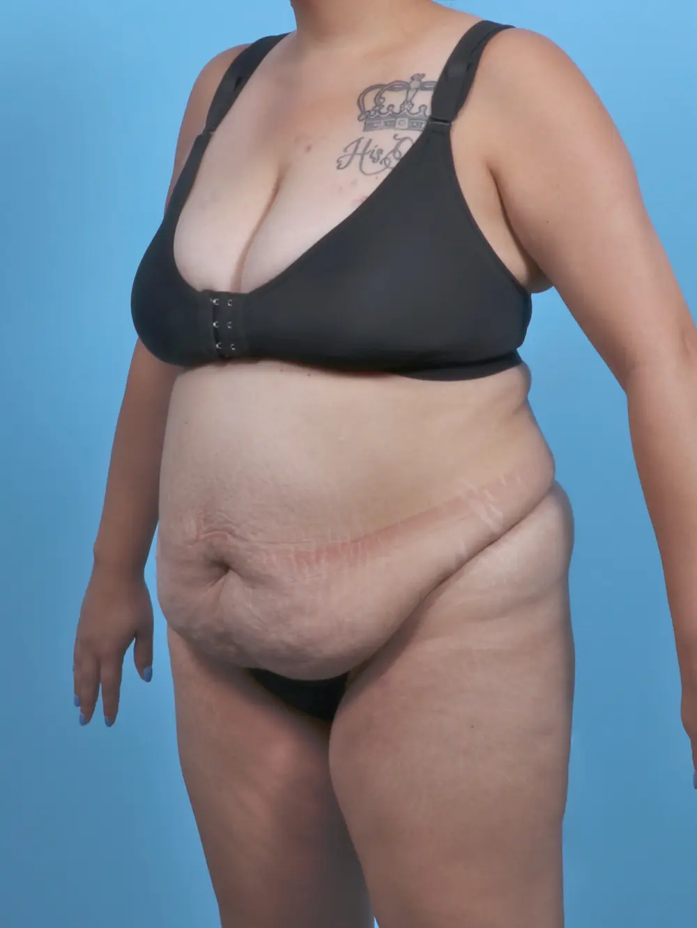 Tummy Tuck Patient Photo - Case 46281 - before view-1