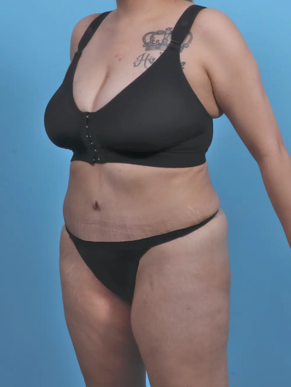 Tummy Tuck Patient Photo - Case 46281 - after view-1
