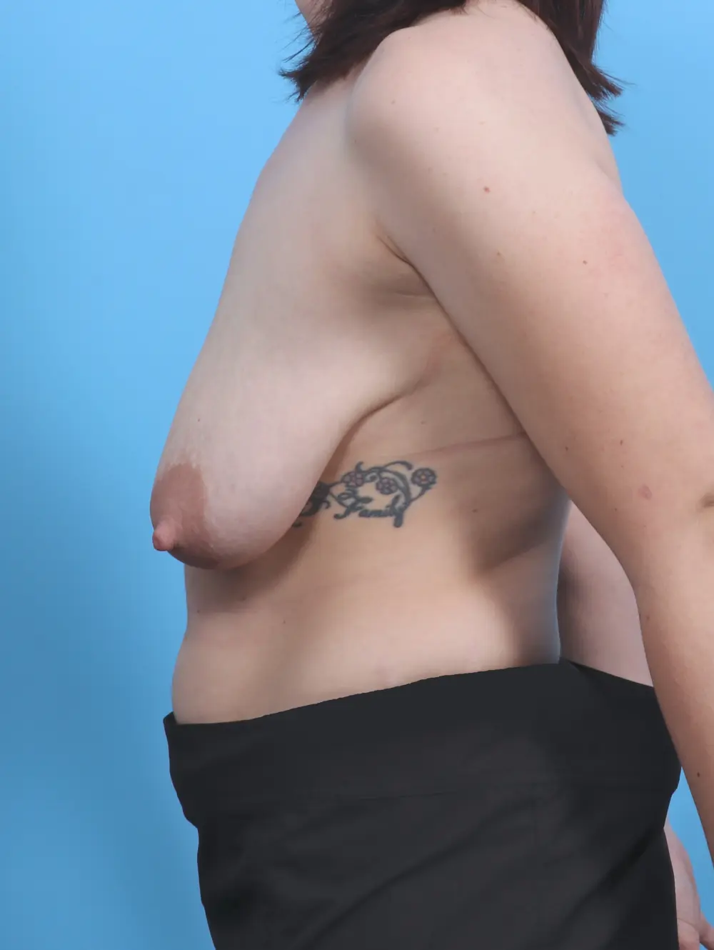 Breast Lift/Reduction with Implants Patient Photo - Case 46292 - before view-2