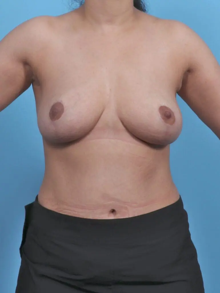 Breast Lift/Reduction w/o Implants - Case 46300 - After