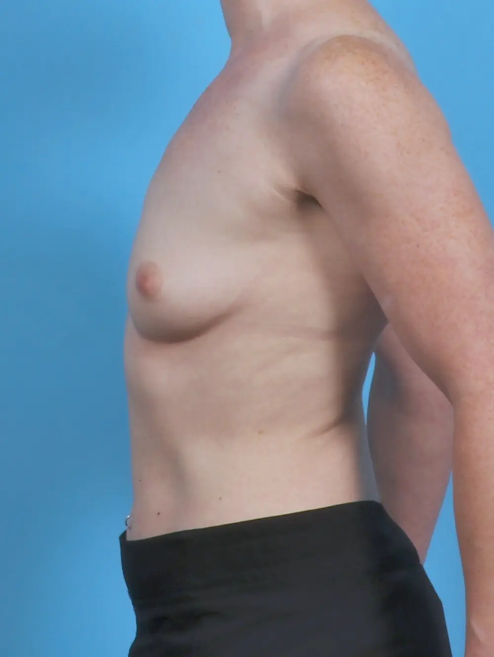 Breast Augmentation Patient Photo - Case 46308 - before view-2