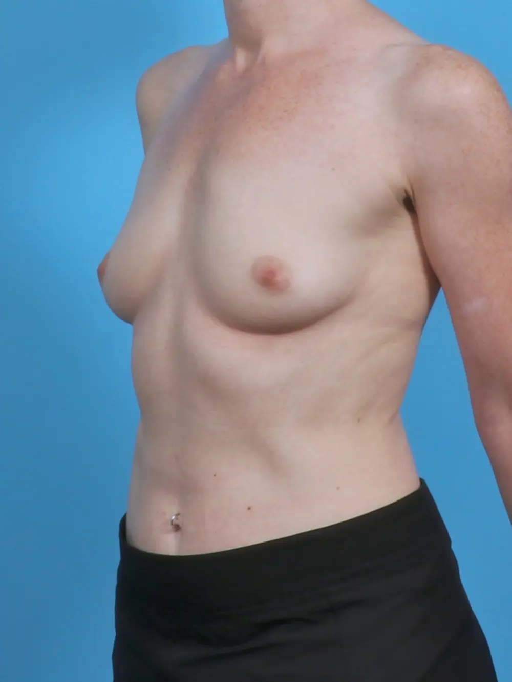 Breast Augmentation Patient Photo - Case 46308 - before view-1