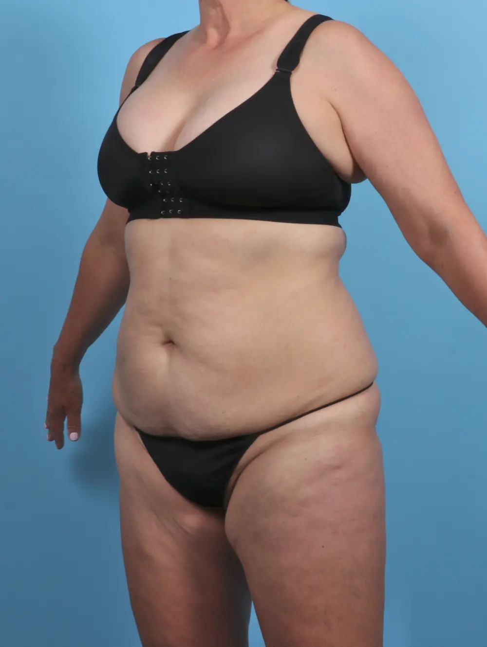 Tummy Tuck Patient Photo - Case 46356 - before view-1