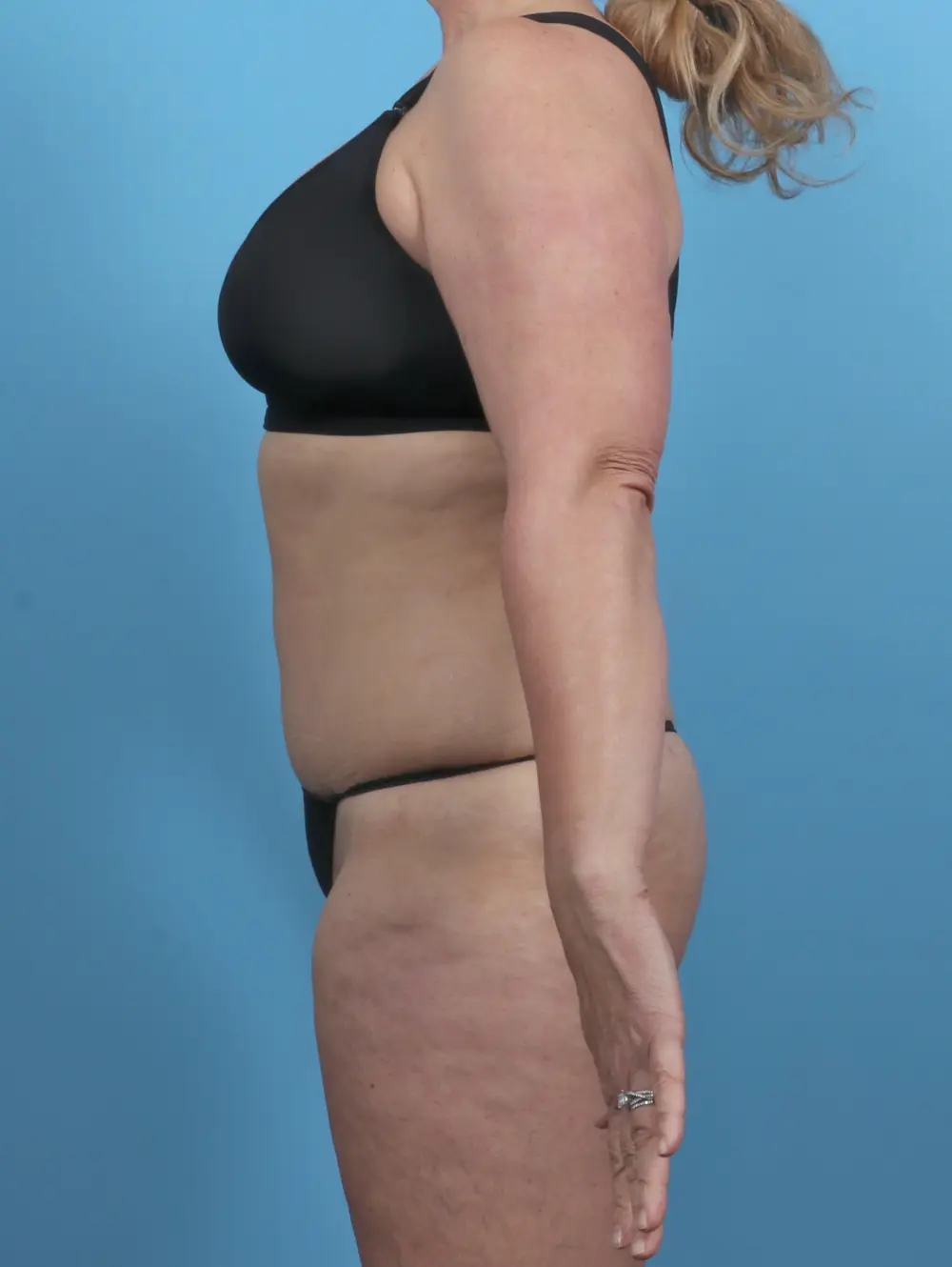 Tummy Tuck Patient Photo - Case 46356 - after view-2