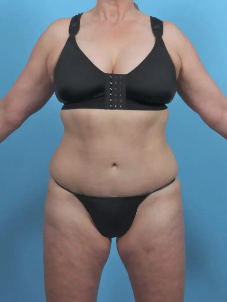 Tummy Tuck - Case 46356 - After