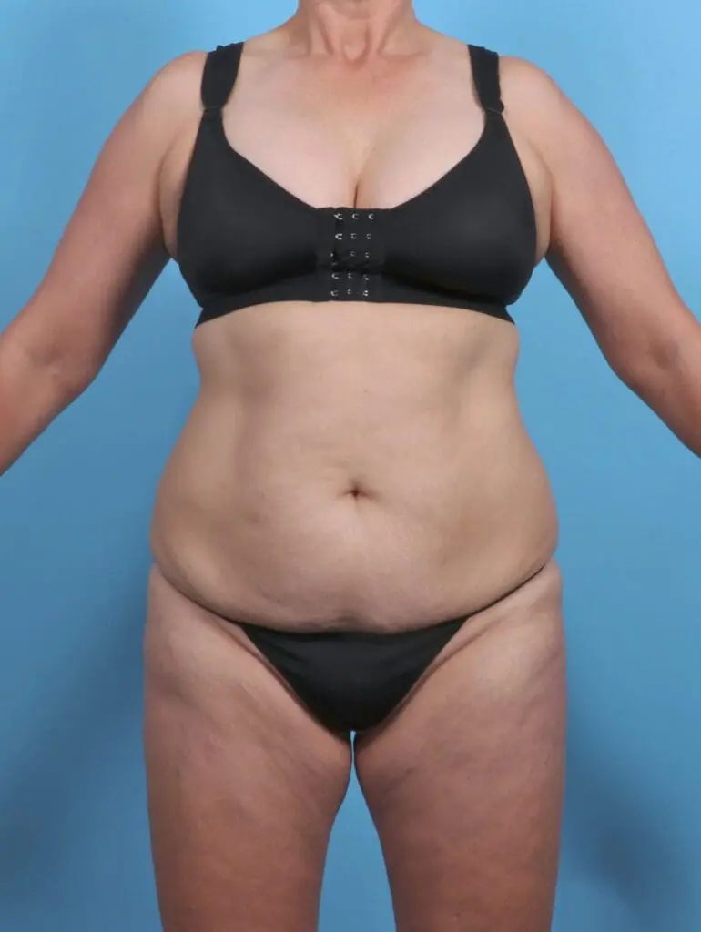 Tummy Tuck - Case 46356 - Before
